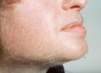 Whizolosophy | Unwanted Facial Hair and PCOS