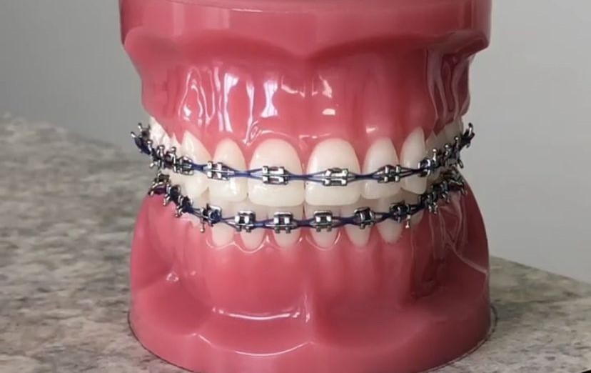 Whizolosophy What Types Of Power Chains Are Available For Braces?